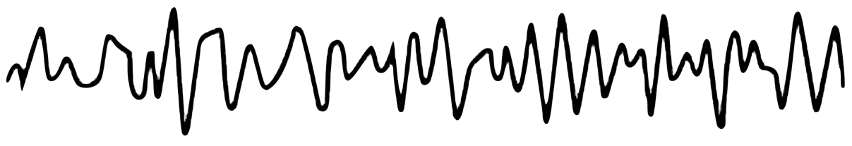 Beta waveform pattern